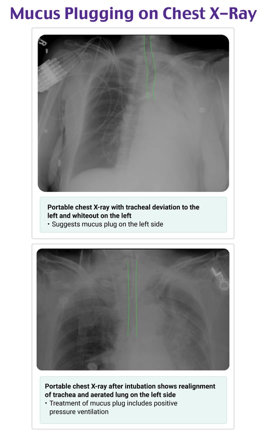 d4050cc4c02afa04e3c7c8195ffefcaf_Image - Mucus Plugging Chest X-ray, Postintubation With Positive Pressure Ventilation @8x