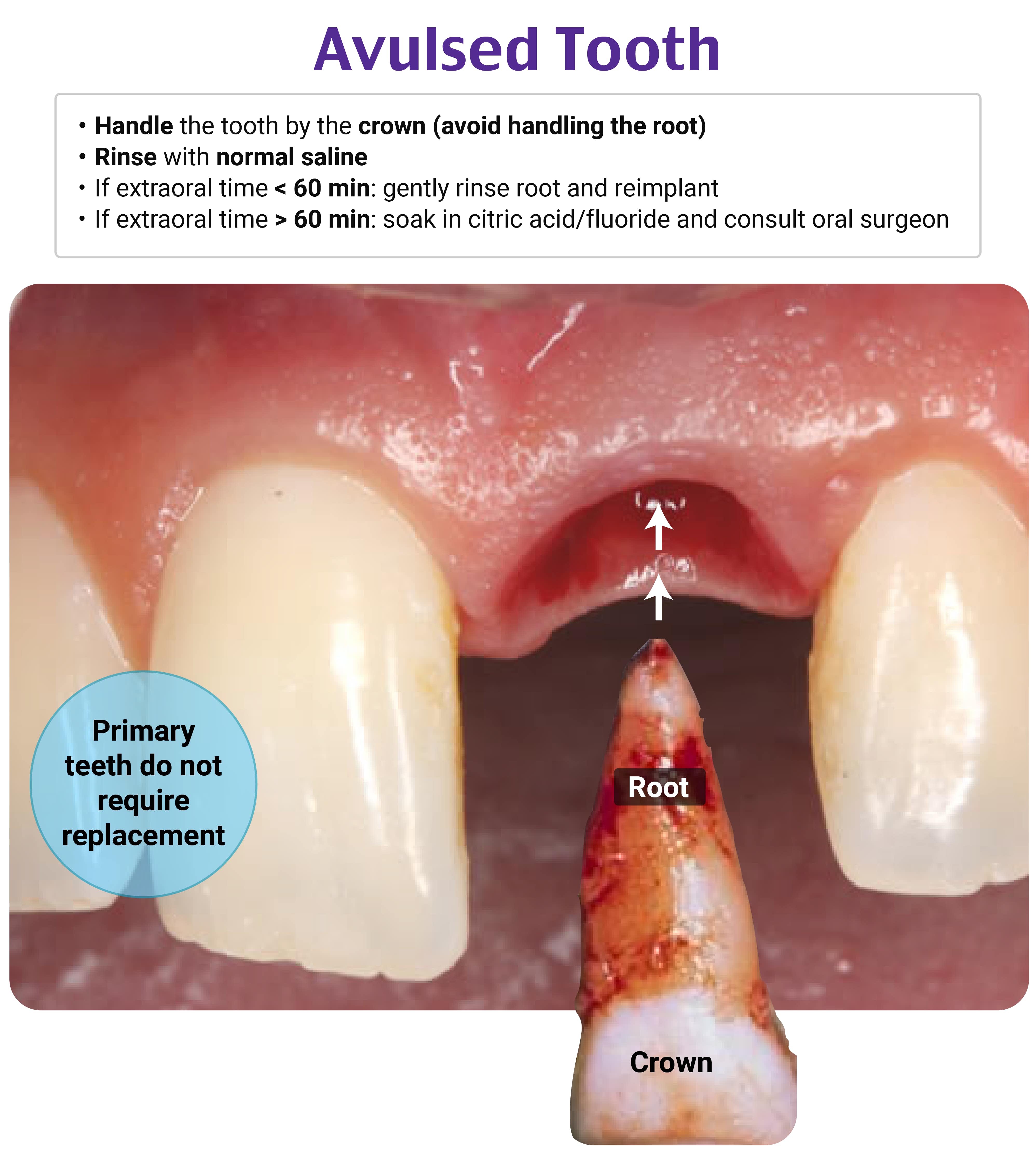 ddba575243bb44fea061df3a351979c5_Image - Dental Avulsion, Tooth Avulsion, Primary teeth, Avulsed @8x